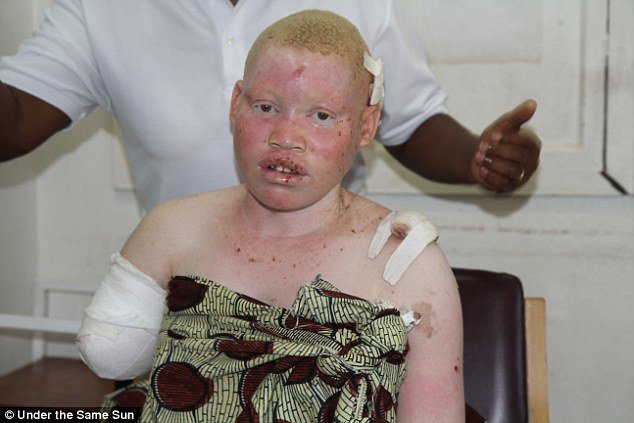 Malavi: Ubilački pohod na ljude s albinizmom potaknut ritualnim praksama