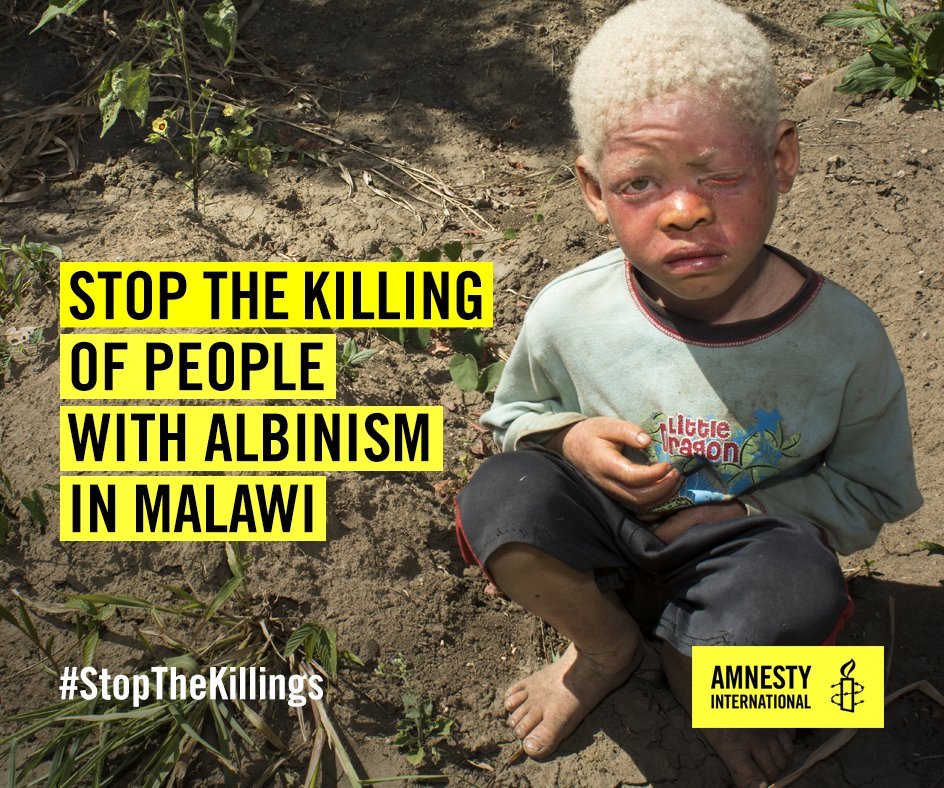 Malavi: Ubilački pohod na ljude s albinizmom potaknut ritualnim praksama