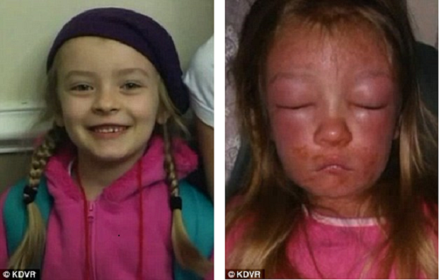 Kalifornija: Nakon kupanja u moru djevojčica dobila bakterijsku infekciju