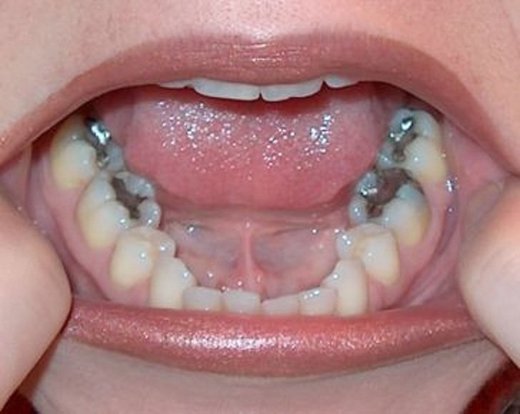 Amalgamska plomba za zube sadrži živu - teški metal jako opasan za zdravlje