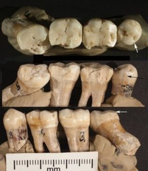 Zubi neandertalaca