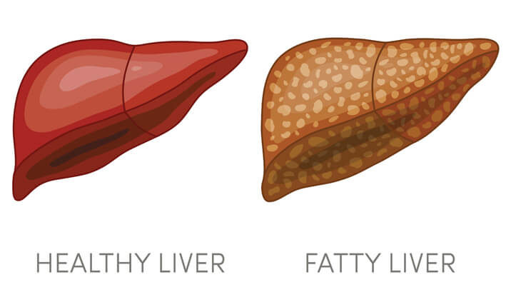 healthy liver fatty liver