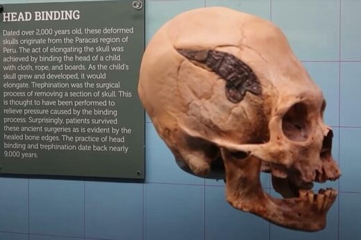 Smatra se da je metalna ploča ugrađena u glavu peruanskog ratnika prije 2000 godina prva operacija lubanje na svijetu