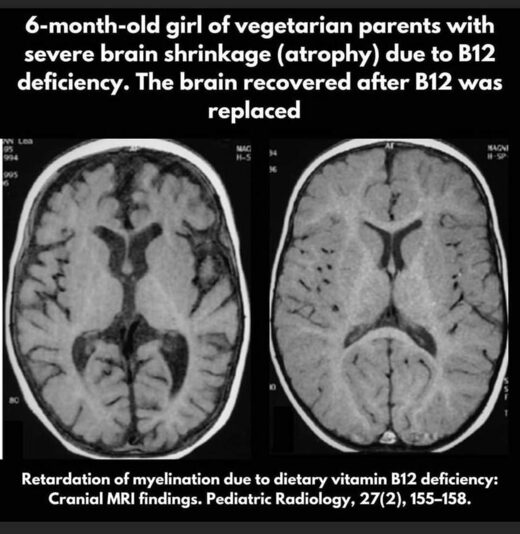brain defect vegan