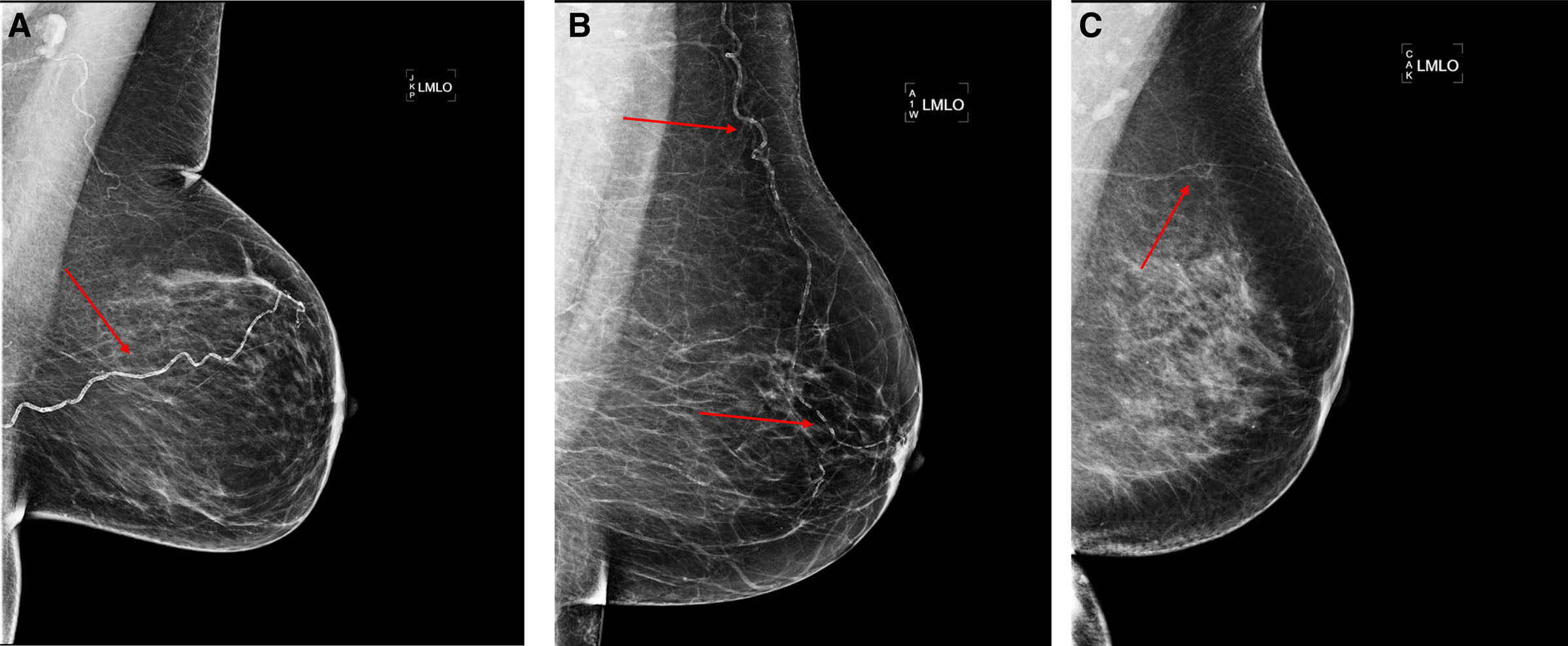 Kalcifikacija arterija dojke (BAC) često se vidi na mamografijama